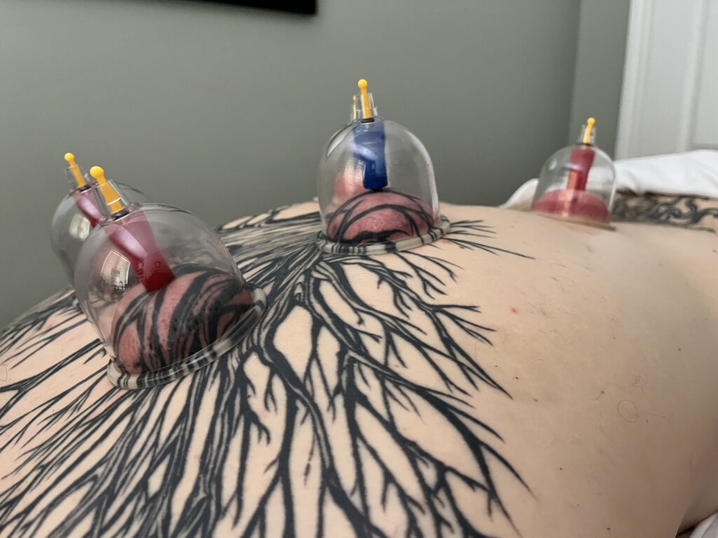 cupping1