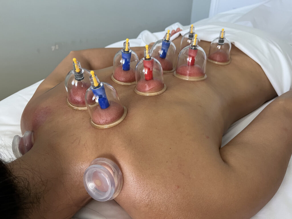 cupping2