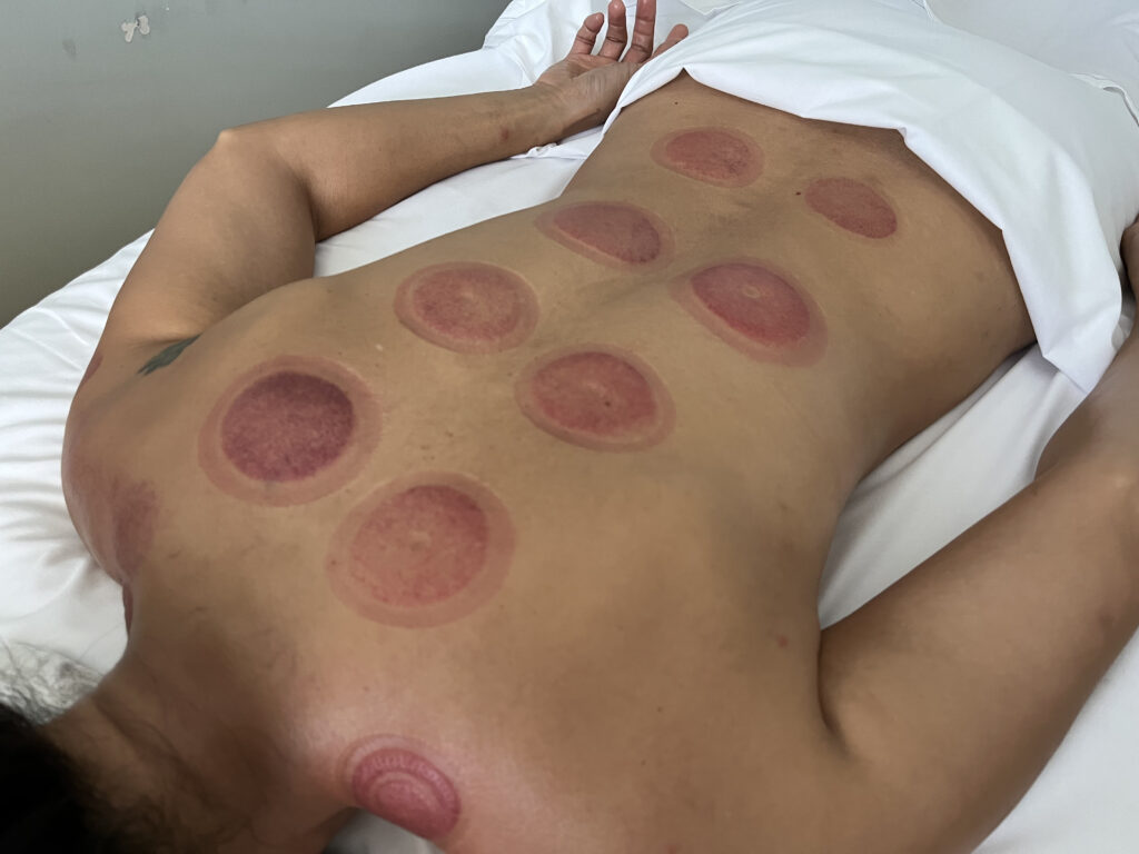 cupping3